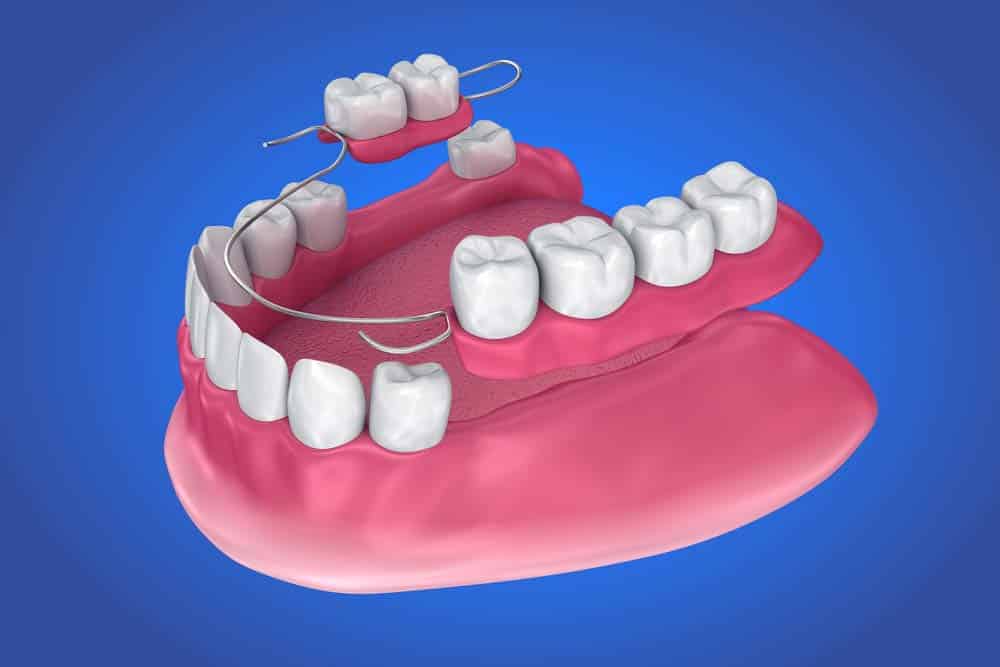 Removable Partial Denture — Mid North Coast Dentures & Mouthguards in Port Macquarie, NSW